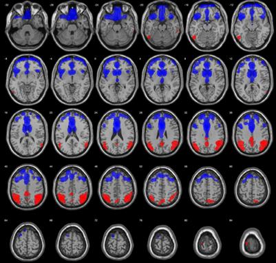 Genetic Algorithms for Optimized Diagnosis of Alzheimer’s Disease and Frontotemporal Dementia Using Fluorodeoxyglucose Positron Emission Tomography Imaging